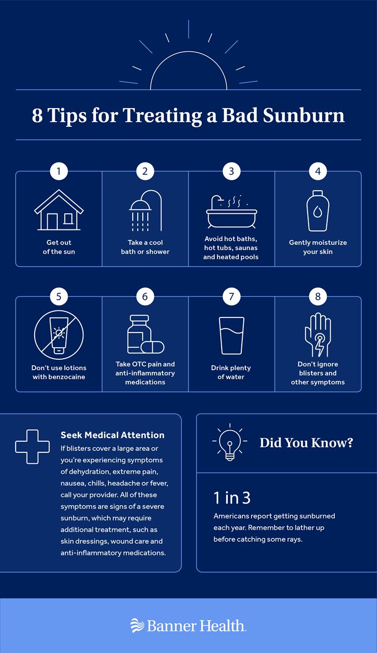 8 Tips for Treating Sunburn Infographic