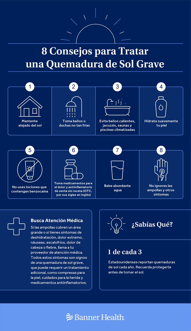 Treating Sunburn Infographic Spanish